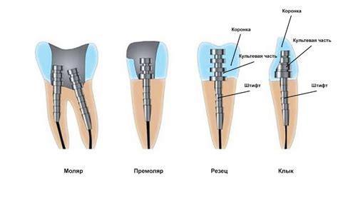 Виды и материалы штифтов для зуба