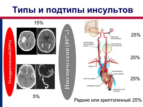 Виды легкого инсульта и их проявления