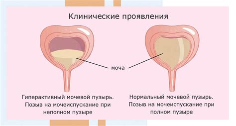 Виды лечения нейрогенного мочевого пузыря