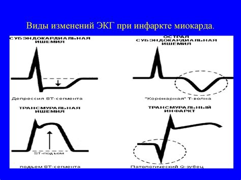 Виды незначительных изменений миокарда