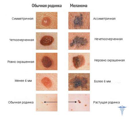 Виды опухолей, развивающихся ниже колена