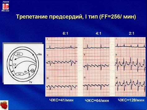 Виды пароксизмальных нарушений ритма