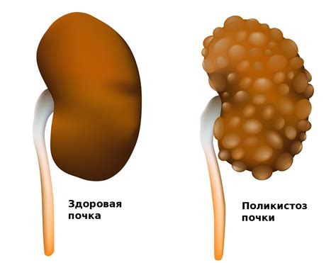 Виды поликистоза почек