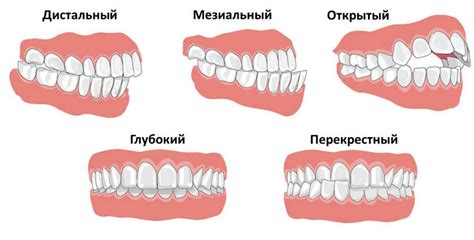 Виды прикуса ножницами