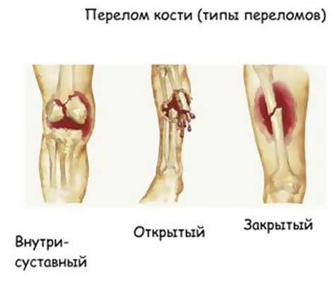 Виды суставных повреждений и их последствия