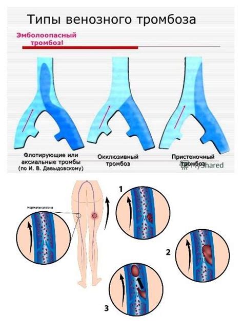 Виды тромбоза и их особенности