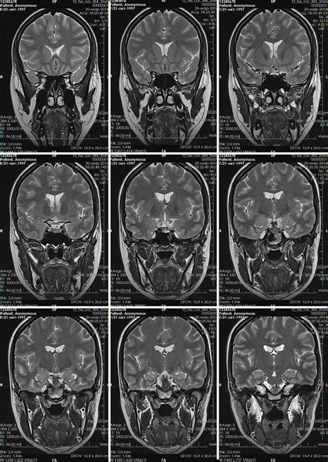 Визуальные проявления на снимках МРТ