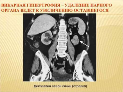 Викарная гиперплазия правой почки