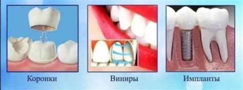 Виниры или импланты: что выбрать?