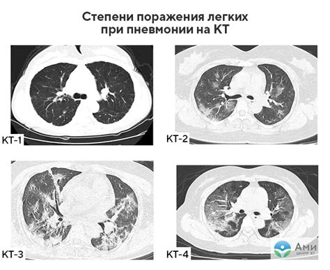 Вирусная пневмония КТ1