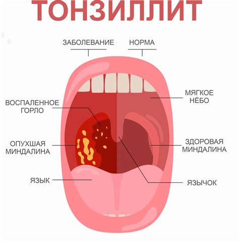 Вирусное воспаление горла: какие симптомы сопровождают желтые гланды