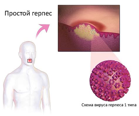 Вирус простого герпеса: полное описание и типы