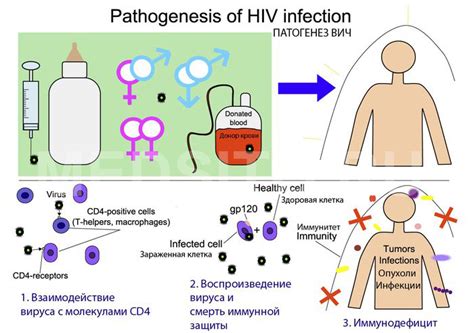 Вич 1: патогенез и развитие болезни