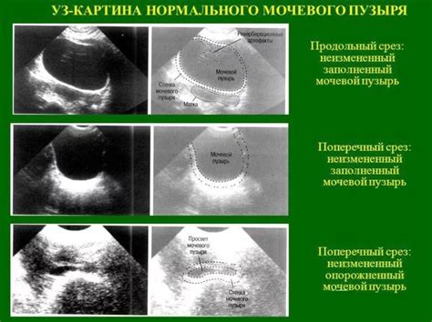 Влияние акустической недоступности на результаты УЗИ