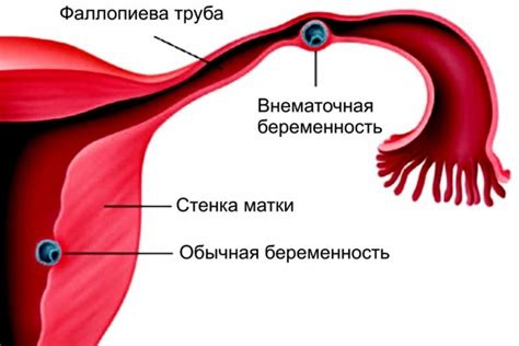 Влияние беременности на повышенную позицию маточной артерии