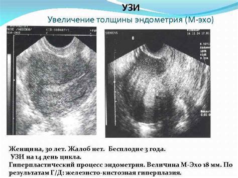 Влияние возраста на толщину эндометрия