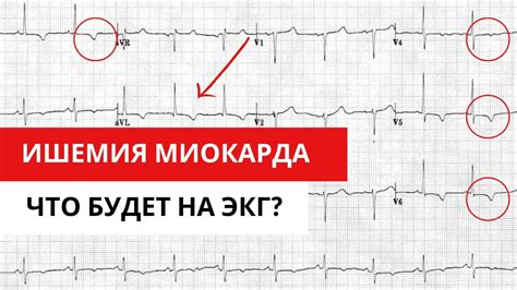 Влияние вольтажа на интерпретацию ЭКГ