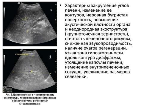 Влияние воспалительных процессов на эхогенность печени