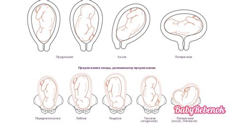 Влияние головного предлежания на беременность