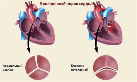 Влияние компенсированного порока сердца на организм