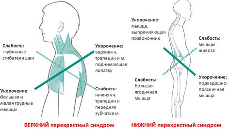 Влияние контралатеральной ягодицы на постуральный контроль