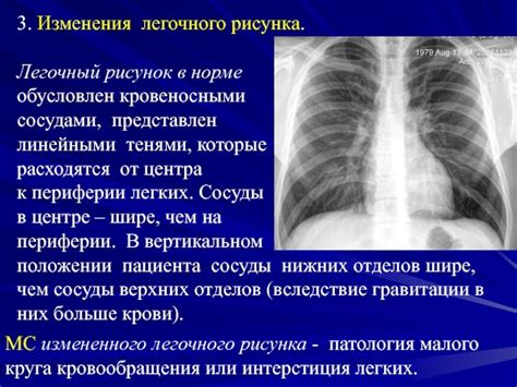 Влияние курения на сгущение легочного рисунка