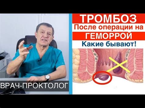 Влияние некоторых причин на надутие шишки геморроя