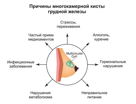 Влияние неоднородного содержимого кисты молочной железы на здоровье