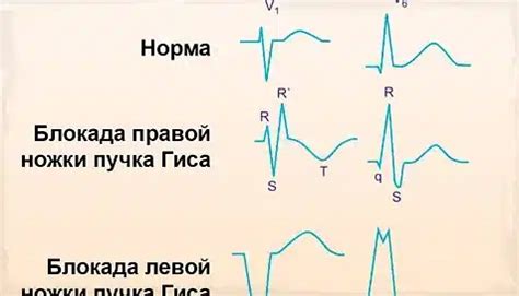 Влияние нетипичной ЭКГ сердца на здоровье