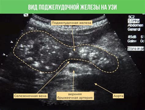 Влияние опухолей на эхогенность и эхоструктуру поджелудочной железы