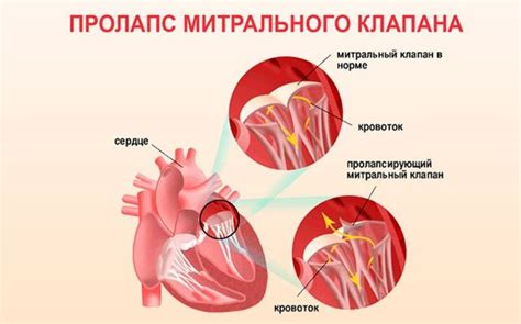 Влияние открытого клапана на функционирование сердца