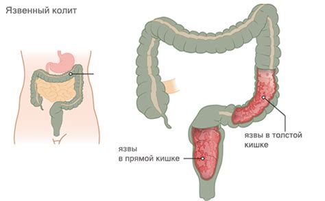 Влияние питания на появление и лечение невыясненного колита