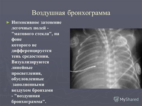 Влияние пневматизации легочных полей на организм