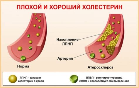 Влияние повышенных уровней липопротеинов низкой плотности у ребенка на здоровье