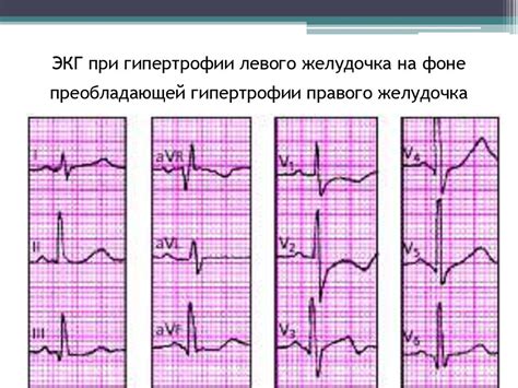 Влияние потенциалов левого желудочка на женское здоровье