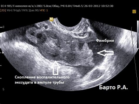 Влияние пробоя маточных труб на вынашивание беременности