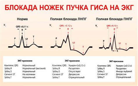 Влияние пучка гиса блокада на организм