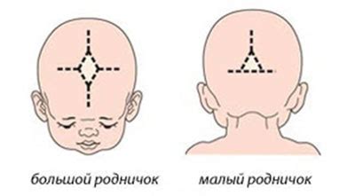 Влияние расхождения родничка на человека