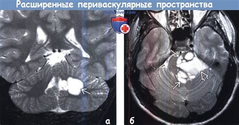 Влияние расширенных периваскулярных пространств на здоровье