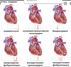 Влияние синусовой тахикардии на сердце ребенка 8 лет: причины, симптомы и лечение