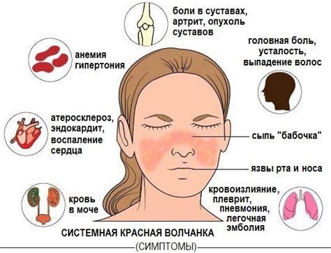 Влияние системной красной волчанки на сердечно-сосудистую систему