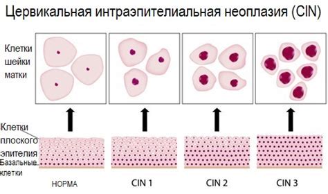 Влияние скопления плоского эпителия на организм