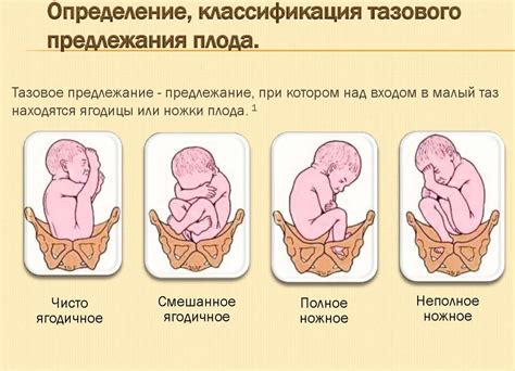 Влияние тазового предлежания на развитие ребенка