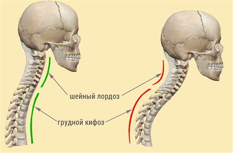 Влияние травм и несвоевременного лечения на возникновение нивелированного шейного лордоза