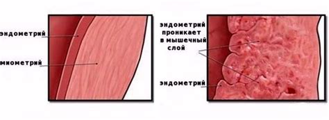 Влияние умеренных диффузных изменений миометрия на организм