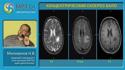 Влияние умеренных диффузных изменений на функции головного мозга