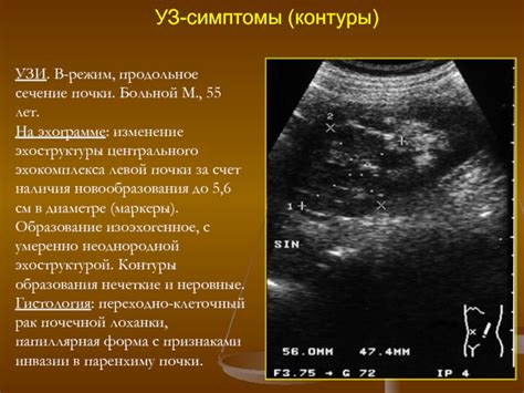 Влияние уплотнения центрального эхокомплекса почки: причины и последствия