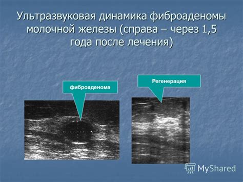 Влияние фиброаденомы без кровотока на организм