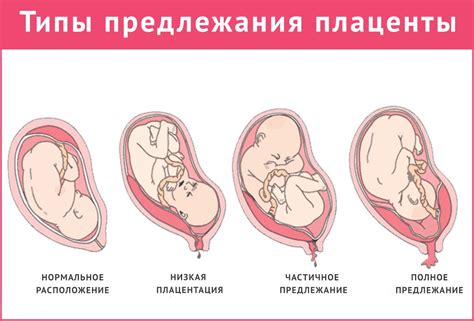 Влияние хориона плаценты по передней стенке на развитие плода