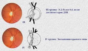 Влияние экскавации зрительного нерва на зрение